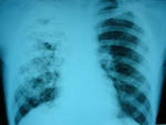 Tuberkules